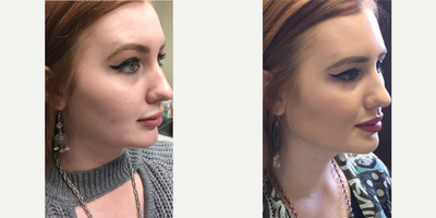 Restylane before and after photo
