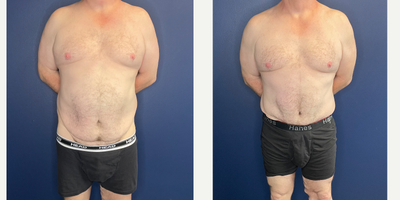 Tummy Tuck before and after photo