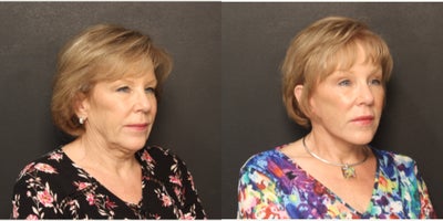 Brow Lift before and after photo