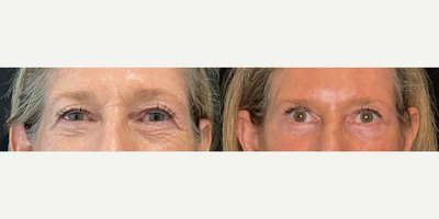 Brow Lift before and after photo