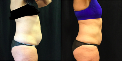 CoolSculpting before and after photo