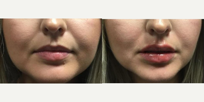 Juvederm before and after photo