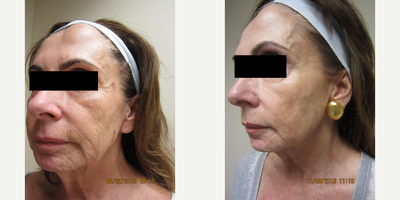 MiXto Laser before and after photo