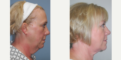 Neck Lift before and after photo