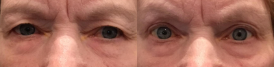 Ptosis Surgery before and after photo