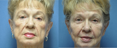 Bellafill before and after photo