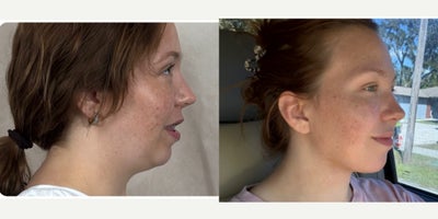 Chin Implant before and after photo