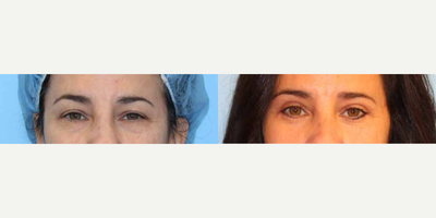 Eyelid Surgery before and after photo