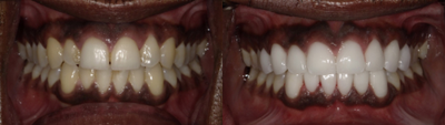 Porcelain Veneers before and after photo