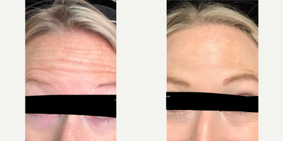 Xeomin before and after photo