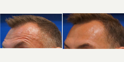 Botox before and after photo