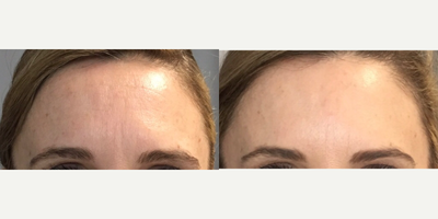 Botox before and after photo