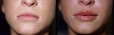 Lip Fillers before and after photo