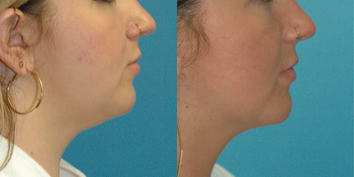 Liposuction before and after photo