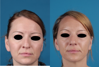 Revision Rhinoplasty before and after photo