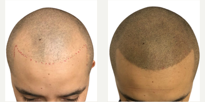 Scalp Micropigmentation before and after photo