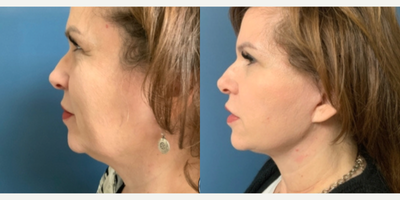 Facelift before and after photo
