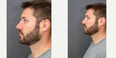 Nonsurgical Nose Job before and after photo