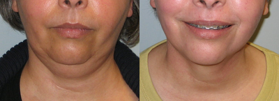Smart Lipo before and after photo