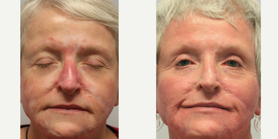 CO2 Laser before and after photo
