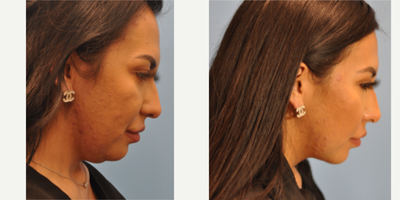 Neck Lift before and after photo