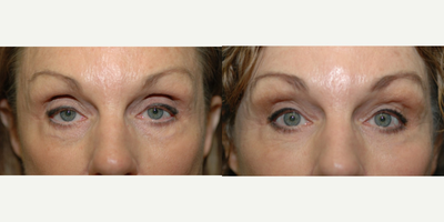 Ptosis Surgery before and after photo