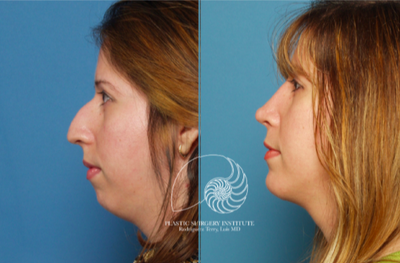 Rhinoplasty before and after photo