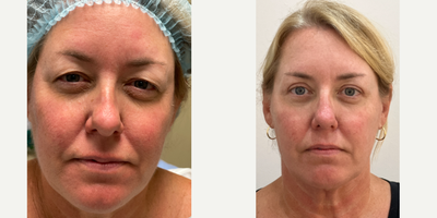 Eyelid Surgery before and after photo