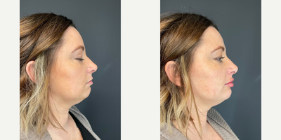Restylane before and after photo