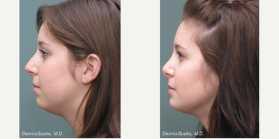 Chin Implant before and after photo
