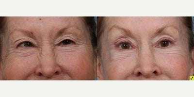 Eyelid Surgery before and after photo