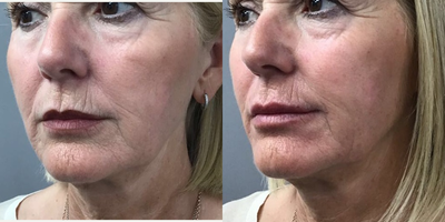 Juvederm before and after photo