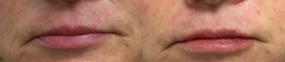 Lip Fillers before and after photo