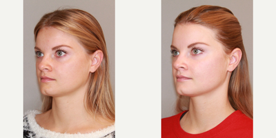 Cheek Lift before and after photo