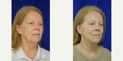 Facial Fat Transfer before and after photo