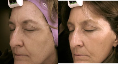 Fraxel Laser before and after photo