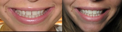 Invisalign before and after photo