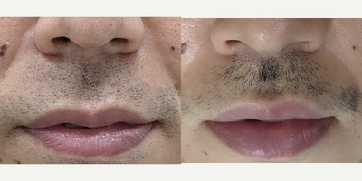 Lip Lift before and after photo