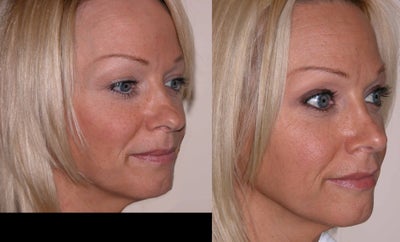 Rhinoplasty before and after photo