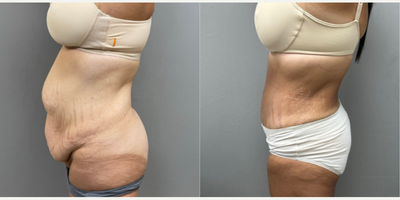 Tummy Tuck before and after photo
