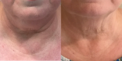 Ultherapy before and after photo