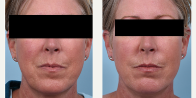 Juvederm before and after photo