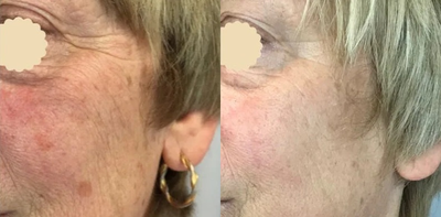 Laser Resurfacing before and after photo