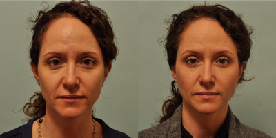Restylane before and after photo