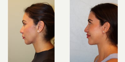 Brow Lift before and after photo