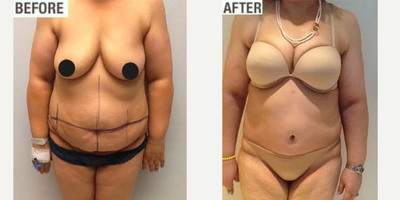 Tummy Tuck before and after photo