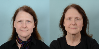 Brow Lift before and after photo
