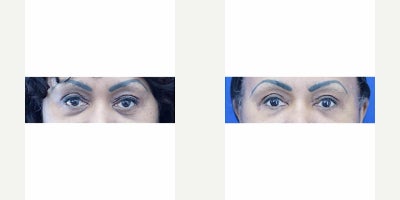 Eyelid Surgery before and after photo