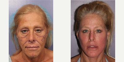 Neck Lift before and after photo