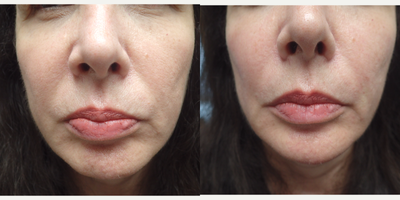 Restylane before and after photo